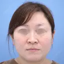 バッカルファット除去 / 脂肪吸引（顔） 湘南美容クリニック 秋葉原院 BEFORE サムネイル用