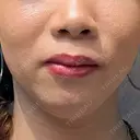 ヒアルロン酸注入（涙袋） 渋谷美容外科クリニック 横浜院 BEFORE サムネイル用