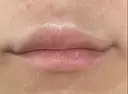 ヒアルロン酸注入（唇） / ボトックス（口角） ブルームクリニック（BLOOM CLINIC） BEFORE サムネイル用