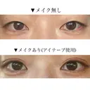 二重埋没 恵聖会クリニック 京橋院 BEFORE サムネイル用