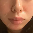 ヒアルロン酸注入（鼻翼基部） ルラ美容クリニック 渋谷本院 BEFORE サムネイル用