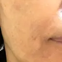 エレクトロポレーション / ピーリング（ハリ・ツヤ） LIFIX BEAUTY CLINIC BEFORE サムネイル用