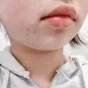 脂肪吸引（顔） ziz CLINIC BEFORE サムネイル用