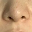 毛穴洗浄（ハイドラフェイシャルなど） 代官山ウィメンズクリニック BEFORE サムネイル用