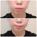 ボトックス（あご） / ボトックス（エラ・小顔） 湘南美容クリニック 新橋銀座口院 BEFORE サムネイル用