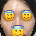 ヒアルロン酸注入（目の下） あじまビューティークリニック BEFORE サムネイル用