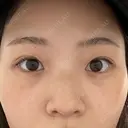 目頭切開 東京エビスクリニック BEFORE サムネイル用