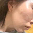 その他（肌） / ダーマペン ジョウクリニック 那覇院 BEFORE サムネイル用