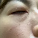 ニードルRF（ポテンツァなど） 表参道スキンクリニック 名古屋院（DAILY SKIN CLINIC提携院） BEFORE サムネイル用