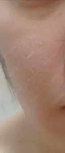 毛穴洗浄（ハイドラフェイシャルなど） / ポテンツァ A CLINIC（エークリニック） 福岡院 BEFORE サムネイル用
