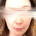 ハイフ（顔） 湘南美容クリニック 岐阜院 BEFORE サムネイル用