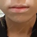 ヒアルロン酸注入（唇） / ボトックス（口角） / その他（輪郭） ルラ美容クリニック 渋谷本院 BEFORE サムネイル用