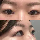上まぶたの脂肪取り 9BeautyClinic BEFORE サムネイル用