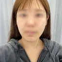 糸リフト / バッカルファット除去 / 脂肪吸引（顔） / 人中短縮 / 脂肪注入（額） / ジョールファット除去 / ヒアルロン酸注入（唇） BLINC CLINIC （ブリンク クリニック） BEFORE サムネイル用