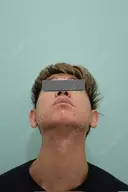 糸リフト / 脂肪吸引（顔） / ジョールファット除去 / 医療痩身（顔） / インディバ（顔） WOM CLINIC GINZA （ワム クリニック ギンザ） BEFORE サムネイル用