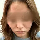 ダーマペン 美容皮膚科しらゆきクリニック BEFORE サムネイル用