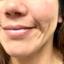 ヒアルロン酸注入（頬） 品川スキンクリニック立川院 BEFORE サムネイル用