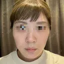 ヴェルヴェットスキン Olino美容外科・美容皮膚科 BEFORE サムネイル用