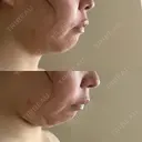 糸リフト / 脂肪吸引（顔） 自由が丘ウェルエイジングビューティークリニック BEFORE サムネイル用