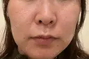 ヴェルヴェットスキン 聖心美容クリニック 広島院 BEFORE サムネイル用