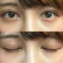 二重切開 / 眼瞼下垂（切開） / 目尻切開 / タレ目形成・グラマラスライン（切開） / ヒアルロン酸注入（涙袋） ジュエリー美容外科 BEFORE サムネイル用