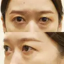 下まぶたの脂肪取り Brandnew Beauty Clinic BEFORE サムネイル用