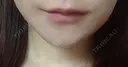 ヒアルロン酸注入（唇） ライアン美容外科 BEFORE サムネイル用