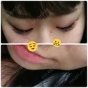 シミ取りレーザー / YAGレーザー 新宿Sクリニック BEFORE サムネイル用