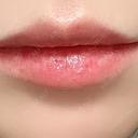 ヒアルロン酸注入（唇） NARU Beauty Clinic 【ナルクリ】 BEFORE サムネイル用