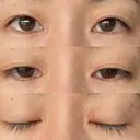 二重埋没 あじまビューティークリニック BEFORE サムネイル用