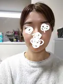 ヒアルロン酸注入（額） / ヒアルロン酸注入（こめかみ） LA CLEF CLINIC（ラクレクリニック） BEFORE サムネイル用