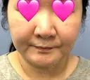 糸リフト / 脂肪吸引（顔） / メーラーファット除去 / ジョールファット除去 湘南美容クリニック 秋葉原院 BEFORE サムネイル用