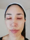 ピーリング（ハリ・ツヤ） まゆりなclinic 名古屋栄 BEFORE サムネイル用