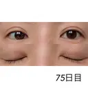 二重埋没 / 目元修正 湘南美容クリニック 広島院 BEFORE サムネイル用