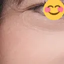 ボトックス（目尻） TCB東京中央美容外科 高崎院 BEFORE サムネイル用