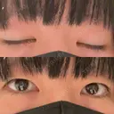 二重埋没 / ハイフ（顔） 日本ウェルネス再生クリニック BEFORE サムネイル用