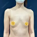 脂肪吸引（脚） / 豊胸（脂肪注入） S.T styleクリニック BEFORE サムネイル用