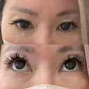下まぶたの脂肪取り Brandnew Beauty Clinic BEFORE サムネイル用
