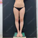 脂肪吸引（脚） 湘南美容クリニック 京都院 BEFORE サムネイル用
