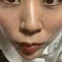 肌ヒアルロン酸注入（たるみ・シワ改善） BAO CLINIC 心斎橋院 BEFORE サムネイル用