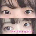 二重埋没 / 上まぶたの脂肪取り 東京ヒルズクリニック 新宿院 BEFORE サムネイル用