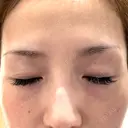 光治療（フォトフェイシャルなど） メディアージュクリニック 青山院 BEFORE サムネイル用