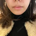 ヒアルロン酸注入（涙袋） / ヒアルロン酸注入（頬） 湘南美容クリニック 東京蒲田院 BEFORE サムネイル用