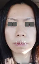 ハイフ（顔） / ハイフ（首） 湘南美容クリニック 宇都宮院 BEFORE サムネイル用