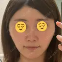 ヒアルロン酸注入（唇） / ヒアルロン酸注入（額） / ヒアルロン酸注入（頬） / ヒアルロン酸注入（こめかみ） ziz CLINIC BEFORE サムネイル用