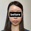 糸リフト / 脂肪吸引（顔） / ヒアルロン酸注入（あご） / ヒアルロン酸注入（こめかみ） BLINC CLINIC （ブリンク クリニック） BEFORE サムネイル用