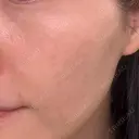 ピコレーザートーニング（美白・肝斑） / フラクショナルレーザー（毛穴・ニキビ跡） おおかみ美容のクリニック 新宿院 BEFORE サムネイル用