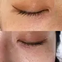 ニードルRF（ポテンツァなど） 表参道スキンクリニック 名古屋院（DAILY SKIN CLINIC提携院） BEFORE サムネイル用