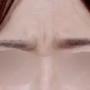 ボトックス（眉間） / ボトックス（額） 日本ウェルネス再生クリニック BEFORE サムネイル用