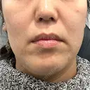 ポテンツァ ドクタープチ美容クリニック -江南店 BEFORE サムネイル用